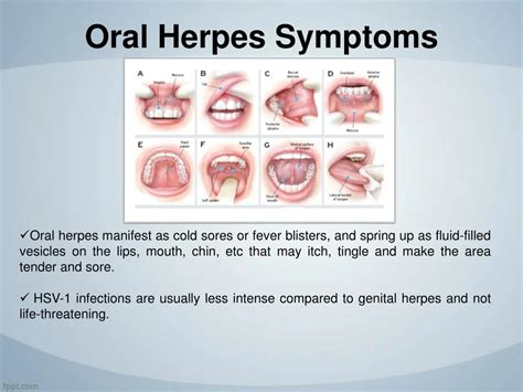 tongue herpes diagnosis